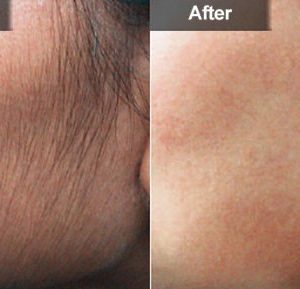 سرم موبر دائمی اپی سافت Episoft (حجم 30 میلی لیتر)