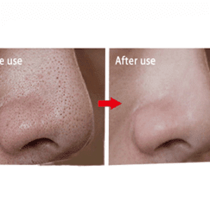 چسب جوش سرسیاه بینی ویونسا VIYONSA حجم 17 میل