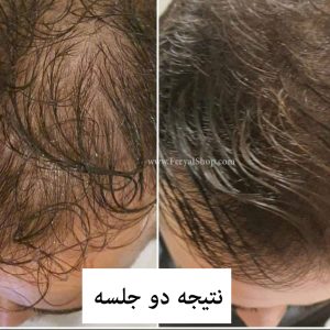 کوکتل رشد مو ماتریکس مدل HR3 ژنوسیس GENOSYS HR3