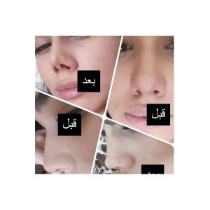 چسب لیفت و فرم دهنده بینی مدل بی رنگ (نامرئی)