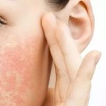 کرم مرطوب کننده پوست بسیار خشک و اگزما