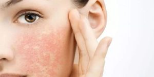 کرم مرطوب کننده پوست بسیار خشک و اگزما