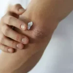 کرم مرطوب کننده پوست بسیار خشک و اگزما